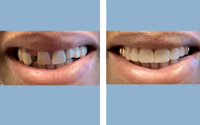 Before and After